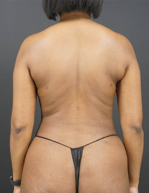 Liposuction case #4349