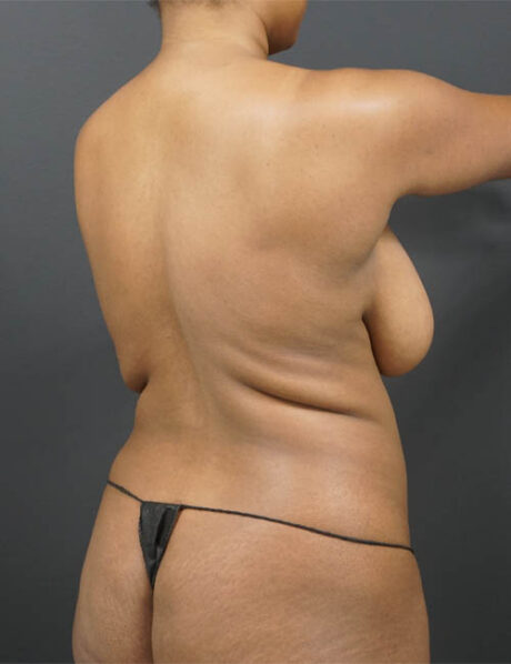 Liposuction case #4349