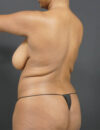 Liposuction case #4349