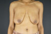 Breast Lift case #4329