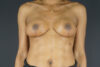 Breast Lift case #4329