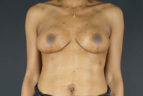 Breast Lift case #4329