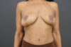 Breast Lift case #4340