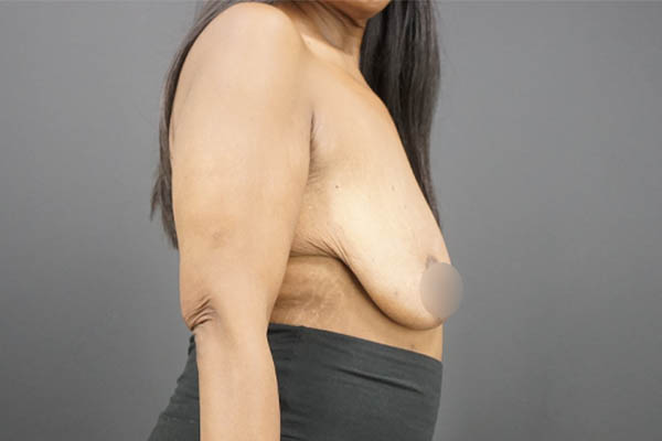 Breast Lift case #4340