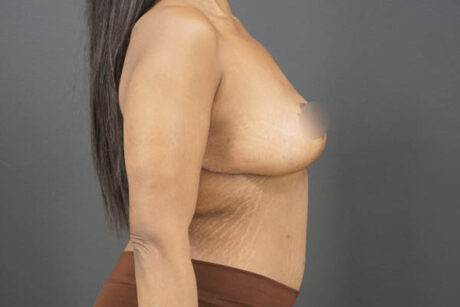 Breast Lift case #4340