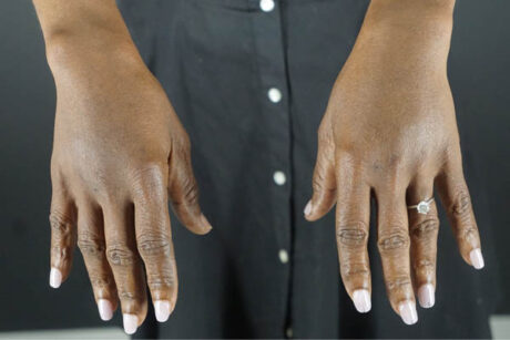 Fat transfer to hands case #4293