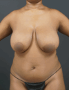 Liposuction case #4349