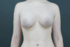 Augmentation Mastopexy case #4296