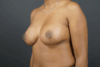 Breast Augmentation case #4307