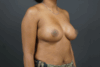 Breast Augmentation case #4307
