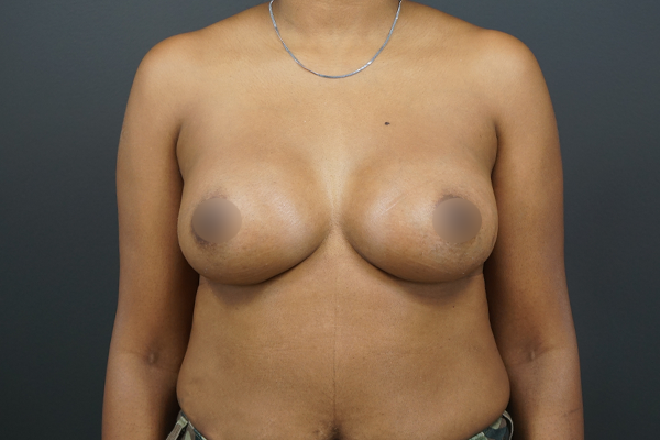 Breast Augmentation case #4307