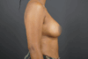 Breast Augmentation case #4307