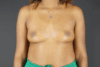 Breast Augmentation case #4307