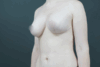 Augmentation Mastopexy case #4296