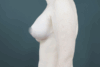 Augmentation Mastopexy case #4296