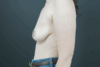 Augmentation Mastopexy case #4296