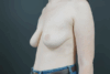 Augmentation Mastopexy case #4296