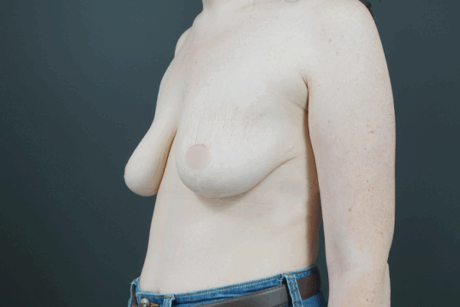 Augmentation Mastopexy case #4296