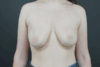 Augmentation Mastopexy case #4296