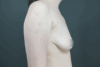 Augmentation Mastopexy case #4296