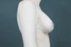 Augmentation Mastopexy case #4296