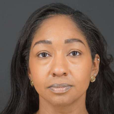 Eyelid Surgery case #4434