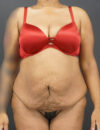 Tummy Tuck case #4567