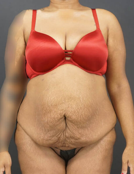Tummy Tuck case #4567