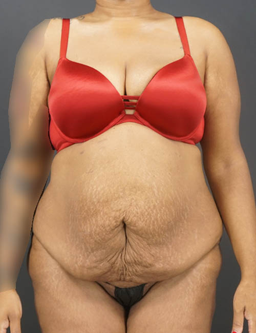 Tummy Tuck case #4567