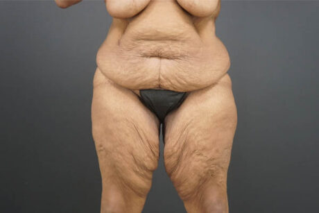 Thigh Lift case #4586