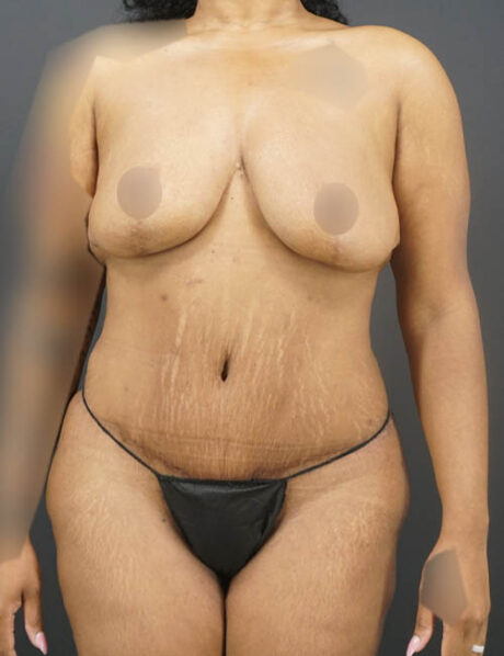 Tummy Tuck case #4567