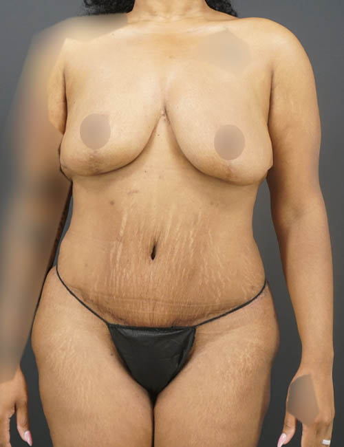Tummy Tuck case #4567