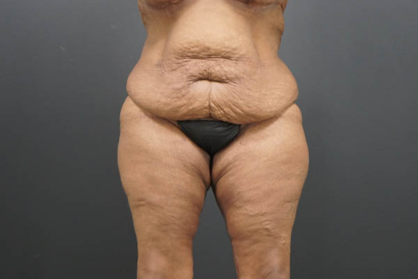 Thigh Lift case #4586