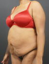 Tummy Tuck case #4567