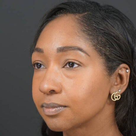 Eyelid Surgery case #4434