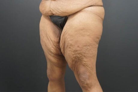 Thigh Lift case #4586