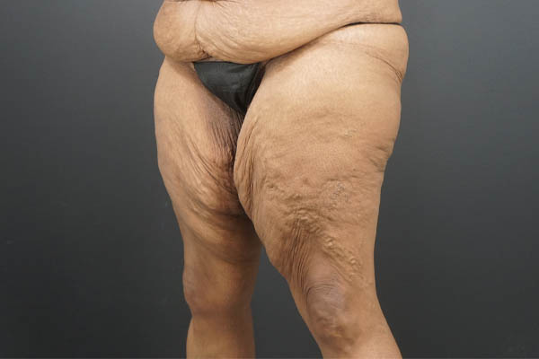 Thigh Lift case #4586