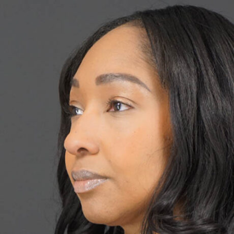 Eyelid Surgery case #4434