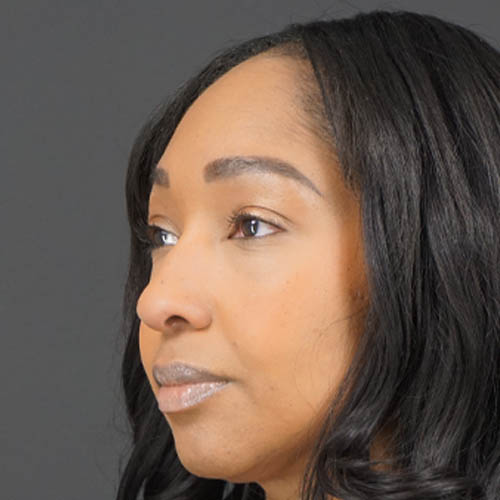 Eyelid Surgery case #4434