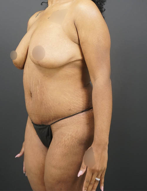 Tummy Tuck case #4567