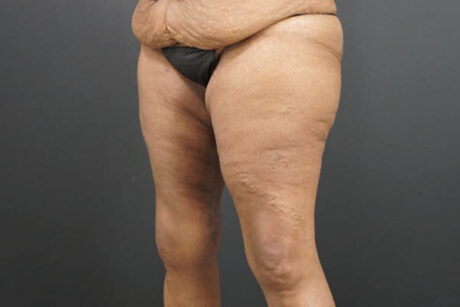 Thigh Lift case #4586