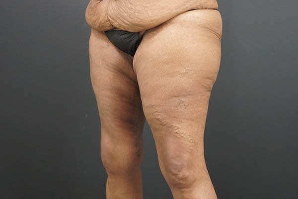 Thigh Lift case #4586