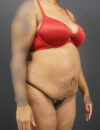 Tummy Tuck case #4567