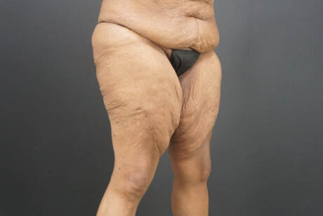 Thigh Lift case #4586