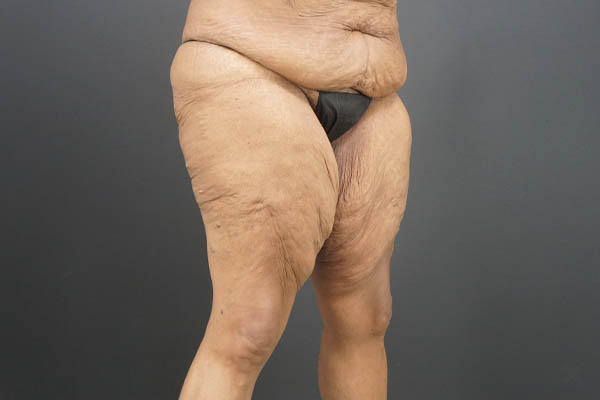 Thigh Lift case #4586