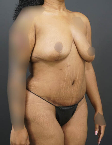 Tummy Tuck case #4567