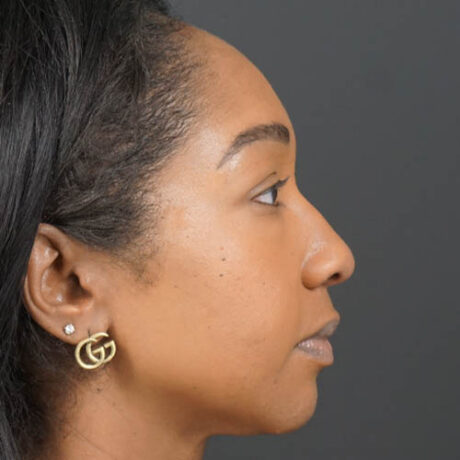 Eyelid Surgery case #4434