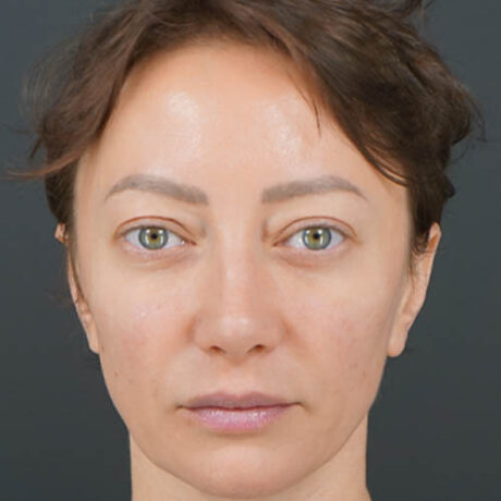 Eyelid Surgery case #4443