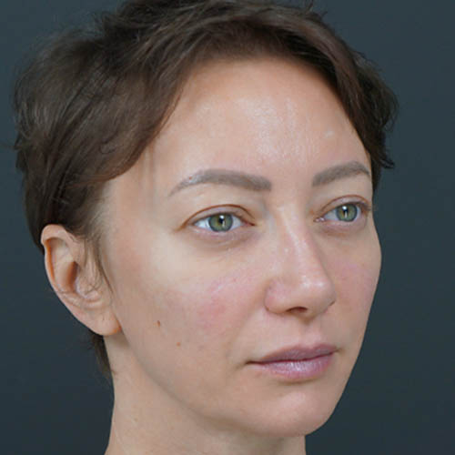 Eyelid Surgery case #4443