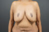 Breast Lift case #4593